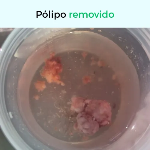 Pólipo removido durante o procedimento de otoendoscopia