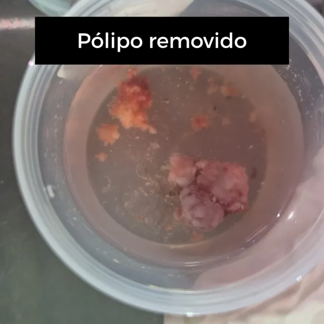 Pólipo removido durante o procedimento de otoendoscopia
